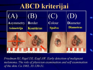 Melanomos atveju tai ABCD (Friedman RJ ir bendraautor., 1985) kriterijai, smulkiai aprayti iame tinklalapyje ir pavaizduoti emiau esaniame Paveiksle 3