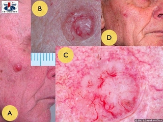 Mazgin, iopjusi bazalioma. A - bendras vaizdas, B - makro vaizdas, C - dermoskopinis vaizdas, D - vaizdas po gydymo