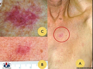 Paviriumi plintanti  bazalioma. A - bendras vaizdas, B - makro vaizdas, C - dermoskopinis vaizdas