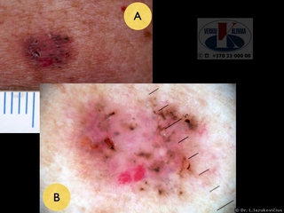 Pigmentuota bazalioma. A - makro vaizdas, B - dermoskopinis vaizdas