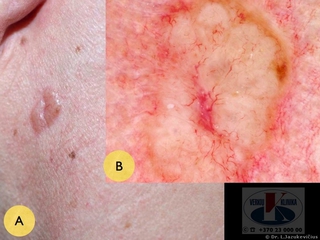 Sklerozuojanti  morphea bazalioma. A - bendras vaizdas, B - dermoskopinis vaizdas
