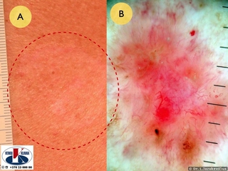 Sklerozuojanti morphea bazalioma A - makro vaizdas, B - dermoskopinis vaizdas
