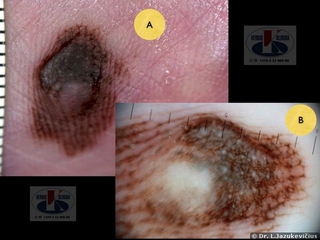Akralinė melanoma. A -  makro vaizdas,  B - dermoskopinis vaizdas