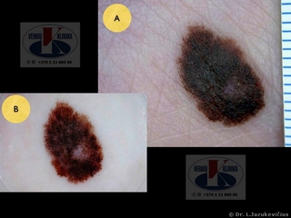 Akralin melanoma. A -  makro vaizdas,  B - dermoskopinis vaizdas