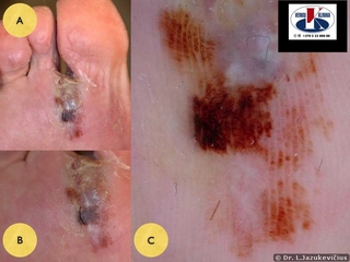 Akralinė melanoma. A - bendras vaizdas, B -  makro vaizdas,  C - dermoskopinis vaizdas