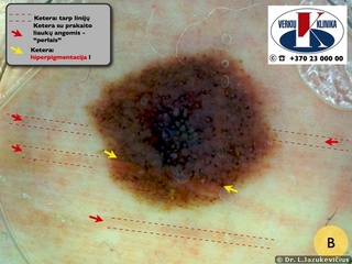 Akralinė melanoma. Dermoskopinis vaizdas