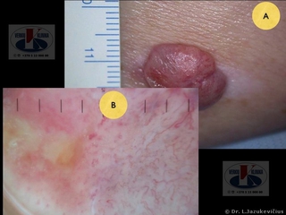 Amelanotinė melanoma. A - makro vaizdas, B - dermoskopinis vaizdas