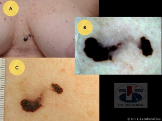 Daugybinės melanomos. A - bendras vaizdas, B - dermoskopinis  vaizdas, C - makro vaizdas