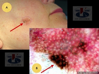Lentigo maligna melanoma. A - bendras vaizdas, B - dermoskopinis vaizdas