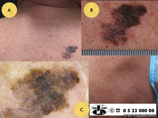 Lentigo maligna melanoma. A - bendras vaizdas, B - makro vaizdas, C - dermoskopinis vaizdas