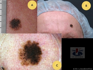Lentigo maligna melanoma. A - bendras vaizdas, B - makro vaizdas, C - dermoskopinis vaizdas
