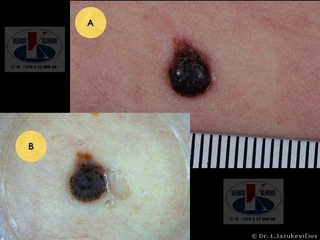 Mazginė melanoma. A -  makro vaizdas,  B - dermoskopinis vaizdas