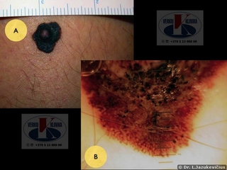 Mazginė melanoma. A -  makro vaizdas,  B - dermoskopinis vaizdas