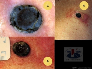 Mazginė melanoma. A - bendras vaizdas, B -  makro vaizdas,  C - dermoskopinis vaizdas