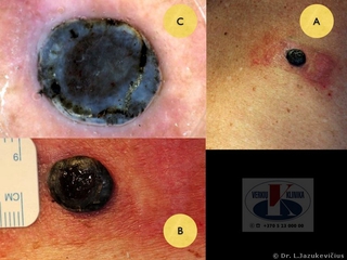 Mazgin melanoma. A - bendras vaizdas, B -  makro vaizdas,  C - dermoskopinis vaizdas