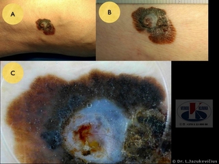 Mazginė melanoma. A - bendras vaizdas, B -  makro vaizdas,  C - dermoskopinis vaizdas