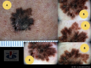 Odos paviršiumi plintanti melanoma. A  -  makro vaizdas,  B - dermoskopinis vaizdas