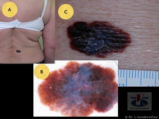 Odos paviršiumi plintanti melanoma. A - bendras vaizdas,  B - dermoskopinis vaizdas, C -  makro vaizdas