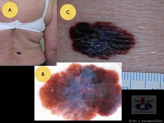 Odos paviriumi plintanti melanoma. A - bendras vaizdas,  B - dermoskopinis vaizdas, C -  makro vaizdas