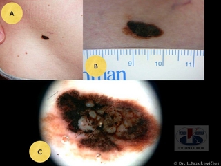 Odos paviršiumi plintanti melanoma. A - bendras vaizdas, B -  makro vaizdas,  C - dermoskopinis vaizdas