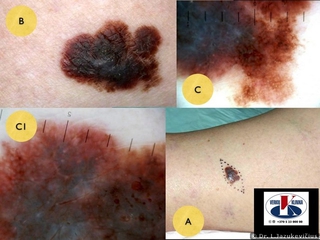 Odos paviršiumi plintanti melanoma. A - bendras vaizdas, B -  makro vaizdas,  C, CI - dermoskopinis vaizdas