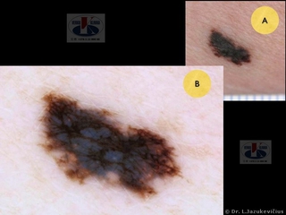 Odos paviršiumi plintanti melanoma. A - makro vaizdas, B - dermoskopinis vaizdas