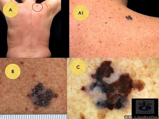 Odos paviršiumi plintanti melanoma. A, AI - bendras vaizdas, B -  makro vaizdas,  C - dermoskopinis vaizdas