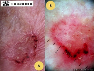 Boweno liga. A -  makro vaizdas, B - dermoskopinis vaizdas