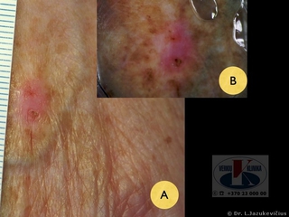 Boweno liga. A - makro vaizdas, B - dermoskopinis vaizdas