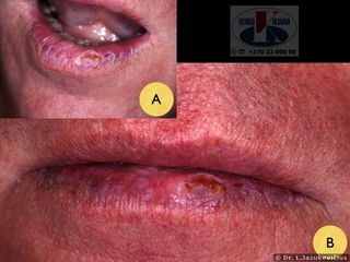 Spindulinis apatinės lūpos raudonio uždegimas (aktininis cheilitas), išsivystęs dėl ultravioletinių spindulių poveikio. A, B - bendras vaizdas