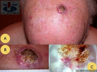 Plokščialąstelinis vėžys. A - bendras vaizdas, B - makro vaizdas, C - dermoskopinis vaizdas