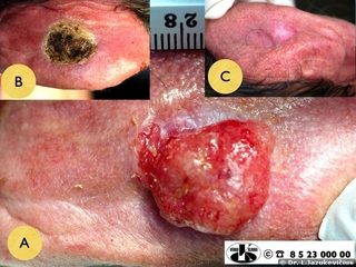 Ausies kaušelio odos plokščialąstelinis vėžys. A - bendras vaizdas, B - vaizdas po operacijos (elektrochirurgijos ir kiuretažo), C - vaizdas po gydymo sugijus operacinei žaizdai