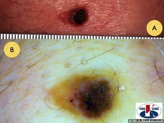 Plokščialąstelinis vėžys. A - makro vaizdas, B - dermoskopinis vaizdas