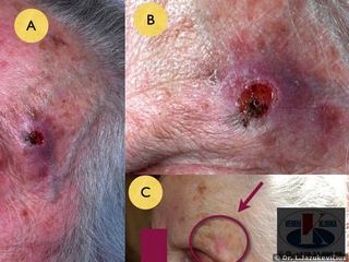 Plokščialąstelinis vėžys. A, B - bendras vaizdas, C - vaizdas po gydymo