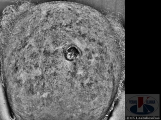 UV Scan - greta esantis vaizdas perdirbtas kompiuterine programa, parykinania spindulins keratozs idinius. Plika akimi j matome maiau