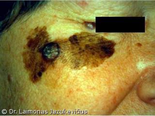 Lentigo maligna melanoma (mazginė forma)