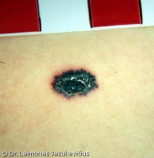 Odos paviriumi plintanti - radialin melanoma