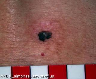 Odos paviršiumi plintanti - radialinė melanoma