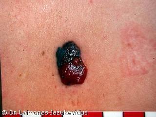 Mazgin iopjusi melanoma