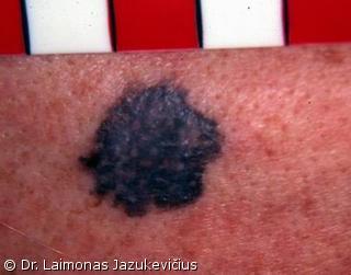 Odos paviršiumi plintanti - radialinė melanoma
