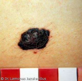 Odos paviriumi plintanti - radialin melanoma