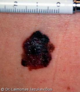 Odos paviriumi plintanti - radialin melanoma