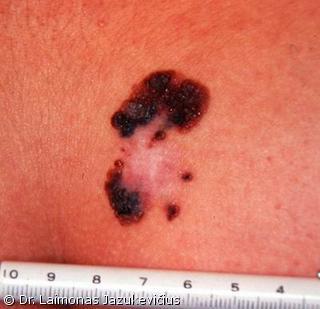 Odos paviršiumi plintanti - radialinė melanoma, su ryškiais regresijos požymiais