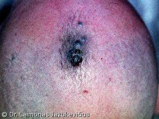 Mazginė melanoma su satelitais