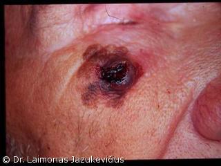 Lentigo maligna melanoma (mazginė forma)