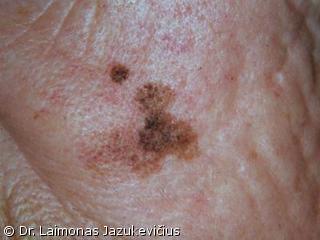 Lentigo maligna melanoma 