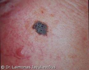Lentigo maligna melanoma (radialinė forma)
