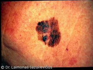 Lentigo maligna melanoma (radialin forma)