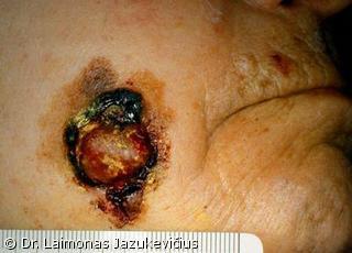 Lentigo maligna melanoma (mazgin forma)