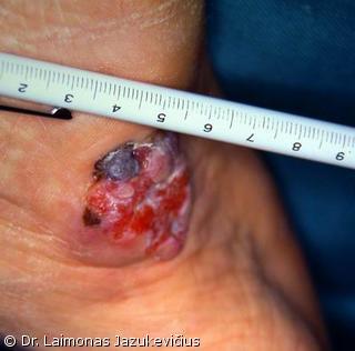 Akralin melanoma